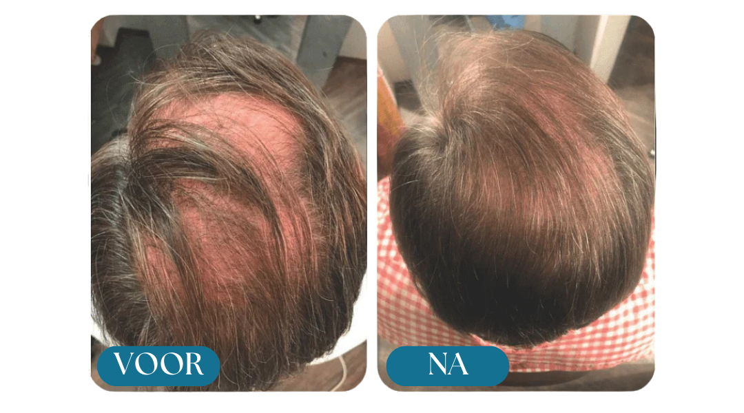 Morge Skin™ Haarwurzel-Aktivator Shampoo