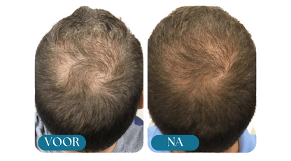 Morge Skin™ Haarwurzel-Aktivator Shampoo